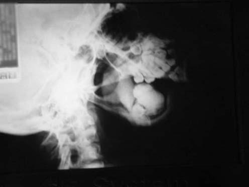 Figura 5 - Instalação de barras de Erich e remoção do dente incluso Figura 3 - Radiografia panorâmica: imagem radiopaca envolvendo o
