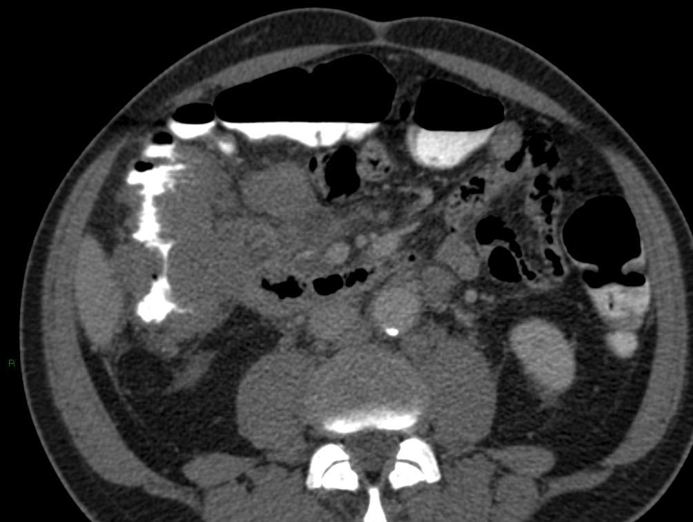 Linfoma Intestinal: