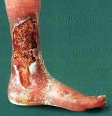 Sintomatologia: Úlceras de Estase ou Varicosas Dor local ou em todo o membro afetado; Cansaço, peso e edema da perna.