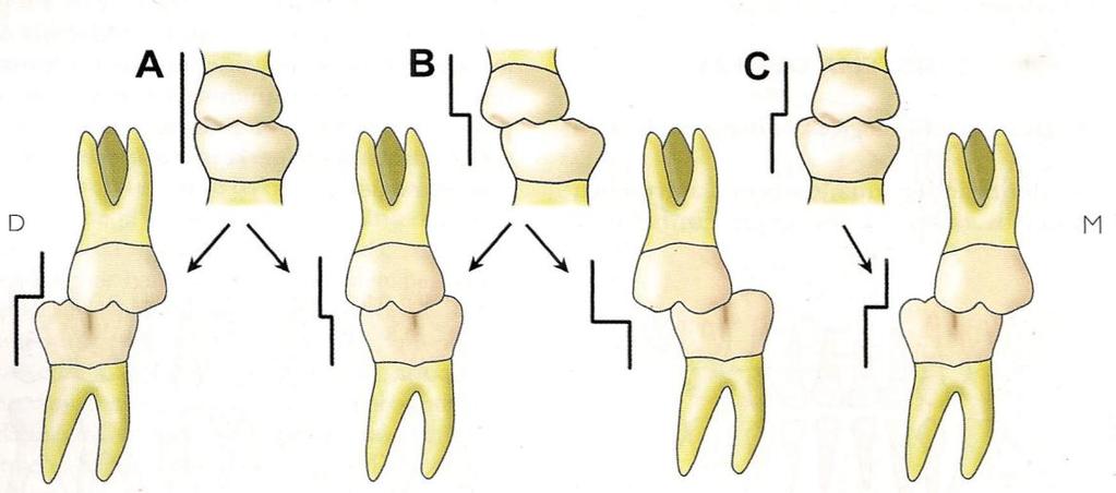 10 Extracções Seriadas Figura 5: Esquema mostrando as diversas relações distais dos segundos molares decíduos orientando os primeiros molares permanentes para uma oclusão de Classe I, II ou III.