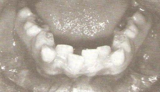 Também Sanin (1970) e os seus colaboradores, mostraram que a medida dos arcos dentários primários e o tamanho dos dentes pode ser usado para predizer a ocorrência de más oclusões em 82% dos casos.
