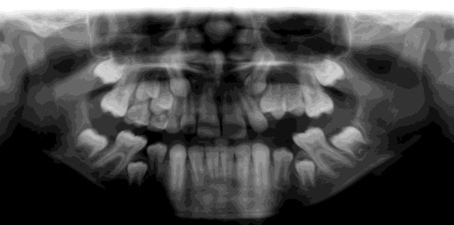 4 Extracções Seriadas É então importante ter uma noção de como a criança se está a desenvolver dentária e esqueleticamente durante o seu período de crescimento.