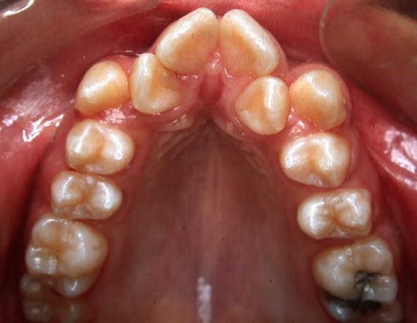 5 Extracções Seriadas Os principais problemas associados com crianças em dentição mista que podem ser tratados com ortodôncia interceptiva são o excesso de espaço, mordidas cruzadas, mordidas