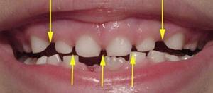 8 Extracções Seriadas Sabe-se que a musculatura é primariamente a forma que possibilita o posicionamento dos dentes em estado de erupção, assim como o alinhamento e reposicionamento de dentes já