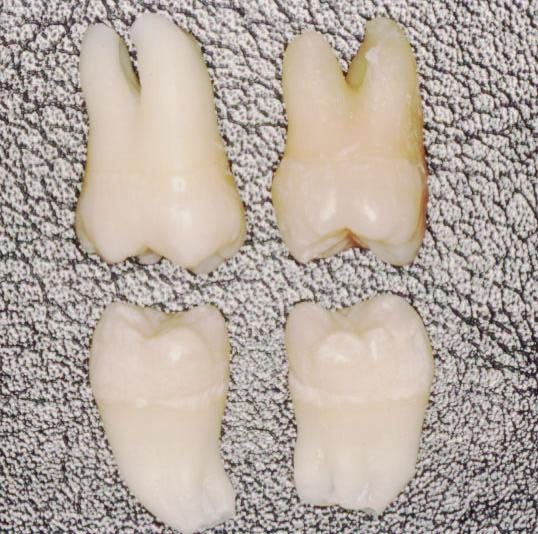 45 4.2 Etapa 2 Fase laboratorial 1 4.2.1 Seleção e preparo dos dentes Após a exodontia dos terceiros molares eles foram imediatamente codificados, em seguida foram limpos em água corrente (FIG.