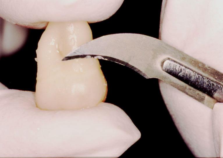 Tais procedimentos visaram manter o colágeno dentinário o mais próximo possível das condições, in vivo, evitando sua desnaturação ou fixação, como ocorre em outros métodos convencionais de
