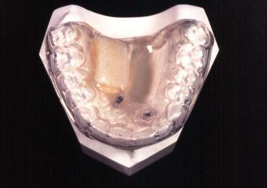 agente clareador. Todo este conjunto era apoiado na placa de acrílico, contendo os discos de dentes experimentais, e na vestibular dos dentes do voluntário (FIG. 6A a 6C).