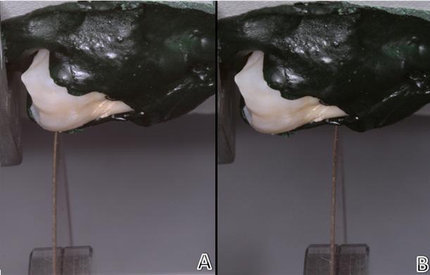 Figura 2: A - Disco posicionado no terço oclusal para corte/remoção do esmalte. B - Disco posicionado abaixo da junção cemento/esmalte para remoção da porção radicular.