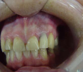 Fig. 7 - Aspecto final do dente 22 após uma semana sem presença de fistula e sintomatologia compactado com um calcador de amálgama.