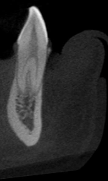 52 Figura 5.3: Corte tomográfico sagital de canino com duas raizes e anatomia Tipo V de Vertucci 5.