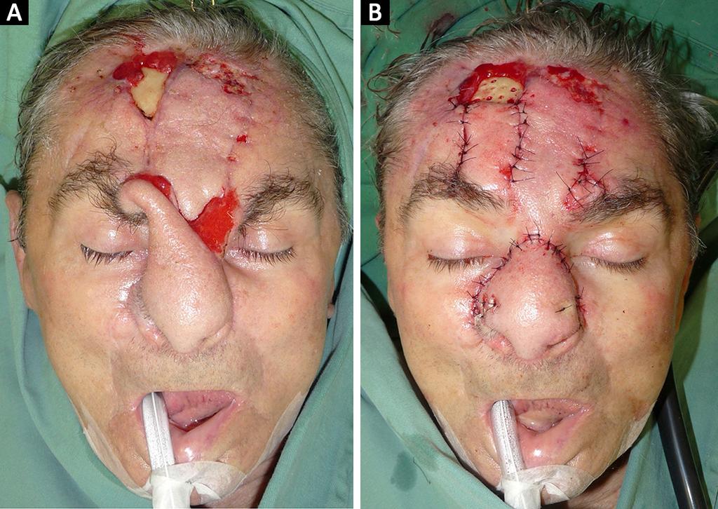 Ramos RFM et al. www.rbcp.org.br Figura 6. A: Pós-operatório de 1 mês e antes da autonomização dos retalhos frontais; B: Após liberação do pedículos vascular.