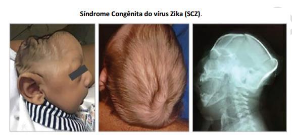 200.000 casos Zika no Brasil 2016 130.