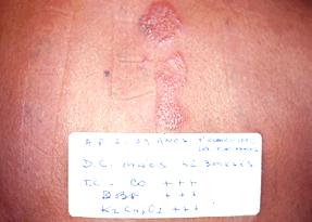 AFS 29 anos pedreiro Eczema agudo pruriginoso nas mãos há 3