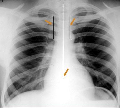 extremidades internas das clavículas não são equidistantes das apófises espinhosas das vértebras doente rodado para a direita Clavículas assimétricas Radiografia do tórax em expiração (sub-exposta)