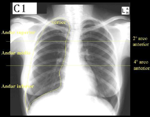 2.3. DIVISÃO DOS CAMPOS PULMONARES Os campos pulmonares (direito e esquerdo) são formados por: Parênquima pulmonar Vasos sanguíneos que se vão bifurcando Cada campo pulmonar é dividido pelas