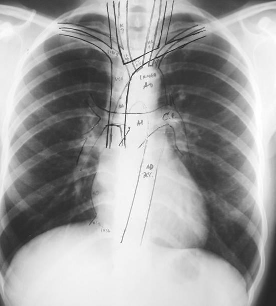 2.7. MEDIASTINO O mediastino é o espaço extrapleural compreendido entre os dois campos pulmonares (pleura parietal mediastínica), constituído por coração, grandes vasos, vasos linfáticos, traqueia,