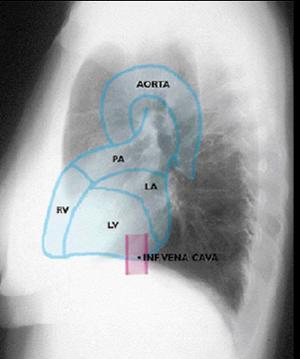 Cintura cardíaca entre a crossa da aorta e o ventrículo esquerdo. Pode perder esta concavidade quando há aumento da aurícula esquerda; ectasia pulmonar.