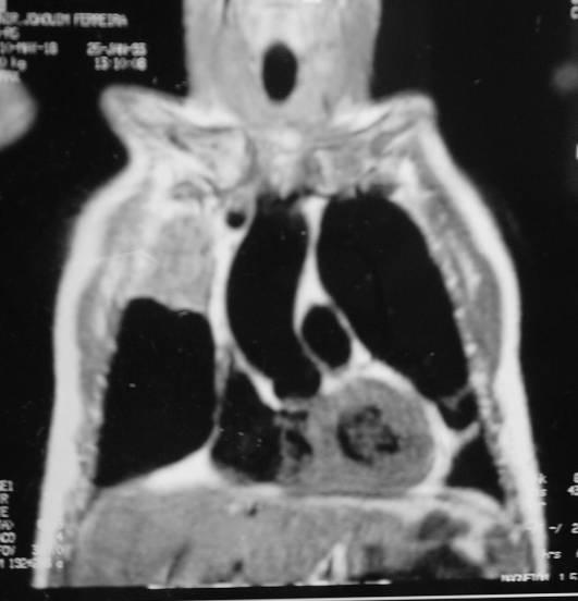 RM em corte coronal ponderada em T1 - Área de densificação heterogénea ocupando o 1/3 superior do pulmão direito (lobo superior) em contiguidade com a pleura mediastínica e