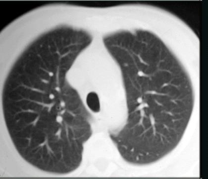 ao ar) Lóbulo superior do pulmão Pouca vascularização e menos retículo ao nível das cisuras pulmonares.