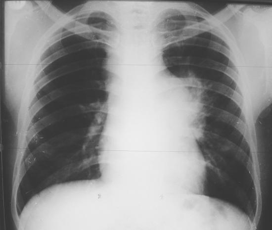 NOTA 1 Aspectos técnicos da radiografia: - Radiografia mal centrada (doente desviado para a direita) - Dose insuficiente (não se adivinha a coluna por trás do coração) - Densidade artificial metálica