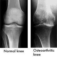 OSTEOARTRITE - Envelhecimento e lesão articular - Resposta inflamatória dos condrócitos - Diminuição de