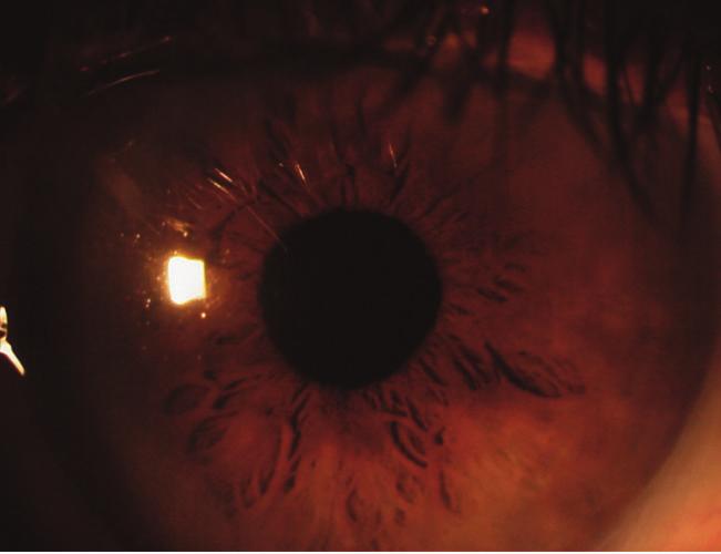 Em cirurgias de catarata não complicadas, OVDs viscodispersivos e dispersivos oferecem uma melhor performance para os cirurgiões Neste olho com catarata grau 4, o OVD usado (BioVisc) não contem