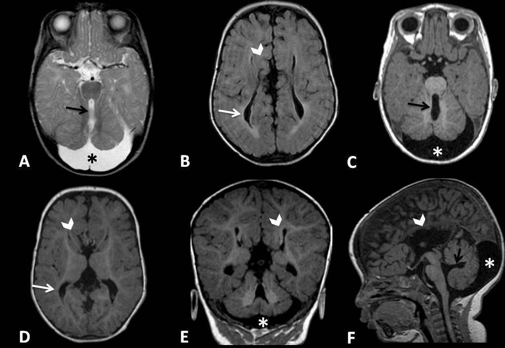 Ressonância Magnética de encéfalo mostrando em A uma imagem axial T2, em B uma imagem axial T2 com atenuação de liquido livre (FLAIR), em C e D imagens T1 axial, uma imagem T1 coronal em E e uma