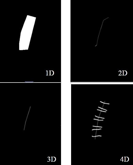 Conf Proc IEEE Eng Med Biol  Detection of Vertebral Compression Fractures in