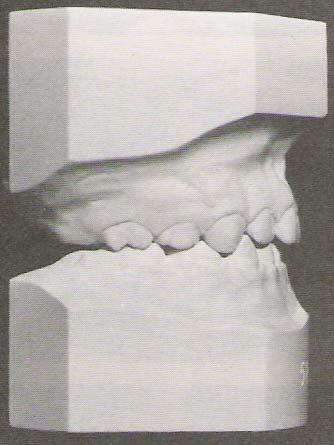 Metodologia 77 inferior; 2) distoclusão ou Classe II, quando a mandíbula encontra-se em posição distal à maxila; 3) mesioclusão ou Classe III, quando a mandíbula encontra-se em posição mesial à
