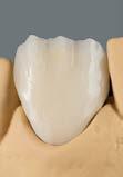 Em caso de espaço limitado ou cores de dente cromadas, recomenda-se a utilização das massas flow CHROMA PLUS. A aplicação ocorre cervicalmente ou na superfície inteira.
