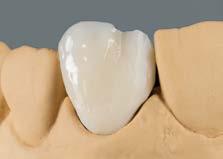 Estratificação BASIC Complemento da forma do dente com flow ENAMEL e/ou flow EFFECT ENAMEL. Alternativamente, a forma dentária é complementada com as massas pastosas ENAMEL/EFFECT ENAMEL.