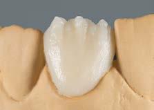 Estratificação com BASE DENTINE 2M2 em forma dentária reduzida. Para esse efeito, aplicar BASE DENTINE em grandes porções.