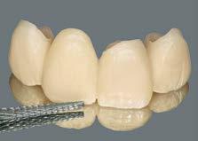 Nota: VITAVMLC PAINT não pode permanecer na superfície e tem de ser completamente recoberta com massas de dentina, esmalte ou flow WINDOW.