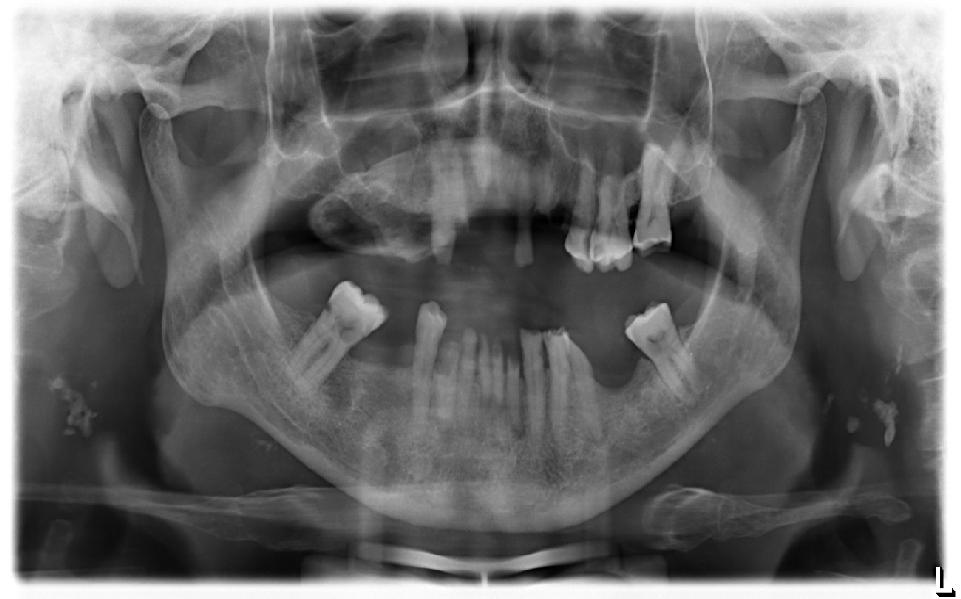 acomete adultos jovens. Há relatos de osteomas periféricos no osso frontal, etmoide e no seio maxilar1,9.