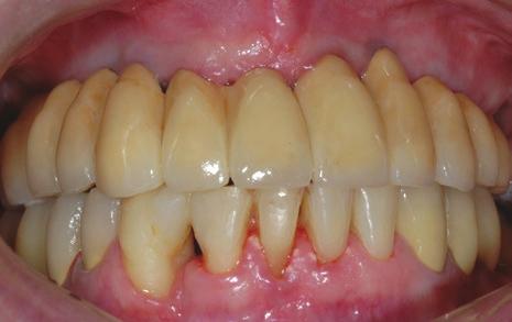 20 Dinato t x u v w Figura 1.4 (continuação) (A) Paciente parcialmente dentado, com problemas periodontais e funcionais.
