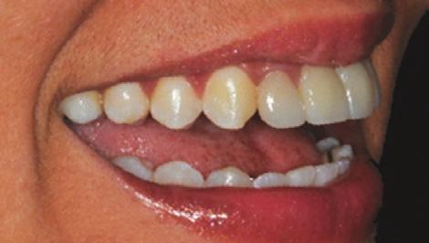 Os dentes 11 e 21