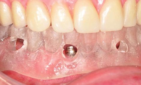 (W) Vista oclusal e prótese tipo protocolo instalada na boca. (X-Z) Caso finalizado.