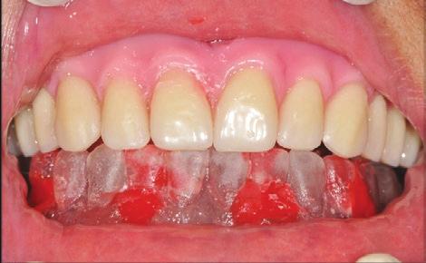 (G-I) Prova dos dentes superiores montados em cera e da guia multifuncional inferior, a qual