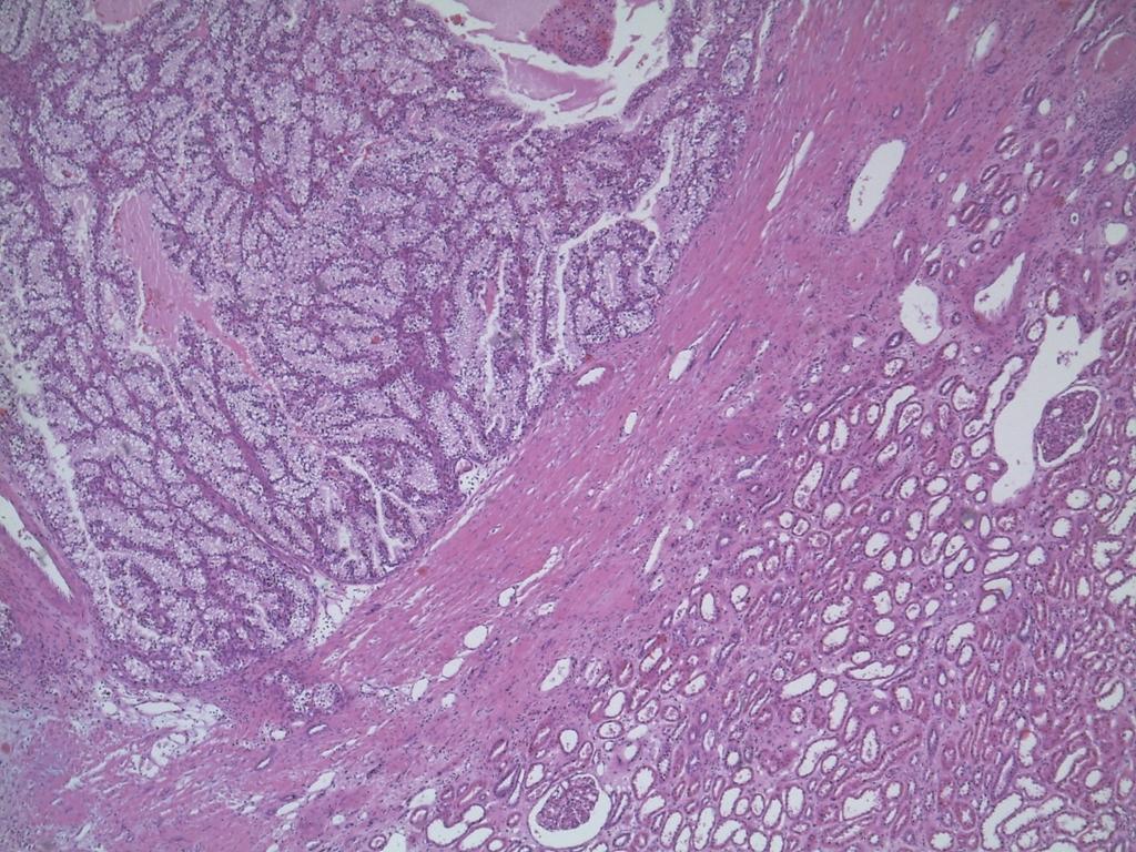 Parênquima renal: túbulos; 2 glomérulos (um deles com alguma atrofia); Interstício com
