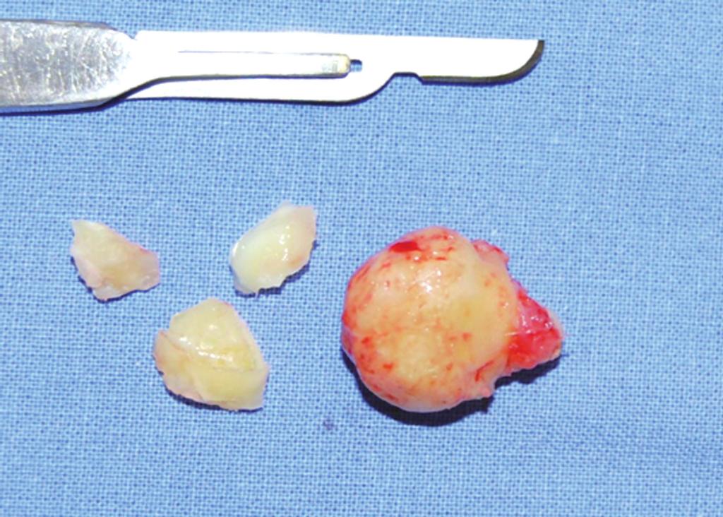 Após descolamento do retalho, seguiu-se a ostectomia da região do abaulamento e acesso ao tecido da lesão, que apresentava uma consistência bastante dura Figura 3. Macroscopia.
