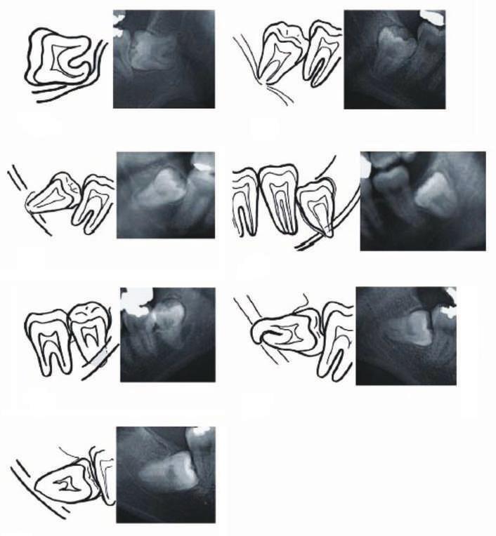 Fig.1C-Escurecimento da Raiz Fig.1D-Interrupção do NAI Figura 1 - Imagens sugestivas de relação próxima entre o terceiro molar mandibular inferior incluso e o nervo alveolar inferior.