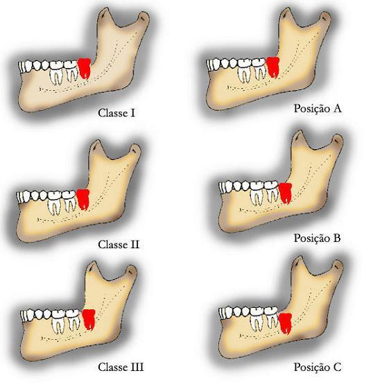 Por sua vez, a classificação de Pell e Gregory relaciona a superfície oclusal do terceiro molar inferior e a do segundo molar adjacente (posição A,B,C) e o diâmetro mesio-distal do terceiro molar