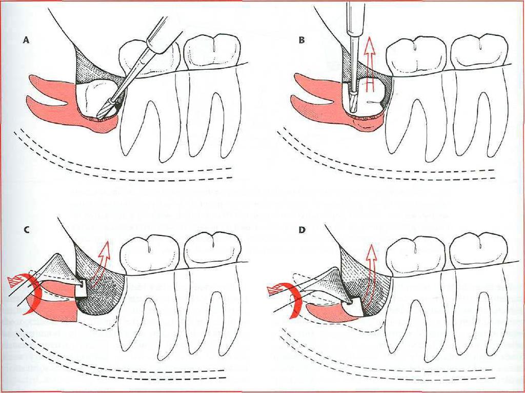 Inclusão horizontal Nas inclusões horizontais, após a realização de uma osteotomia para permitir o acesso à região coronal da raiz distal, e à vasta área da superfície vestibular da coroa, procede-se