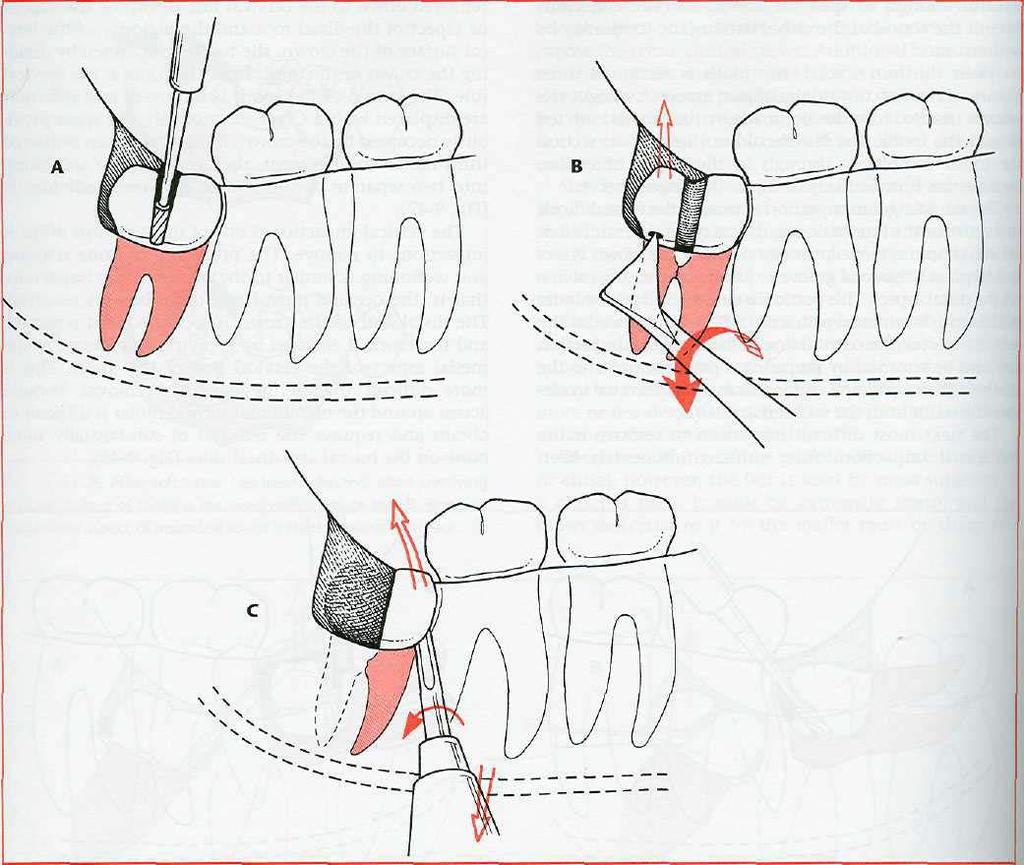 Inclusão Vertical A exodontia dos terceiros molares inferiores, com inclusão vertical, pode ser tecnicamente complexa.