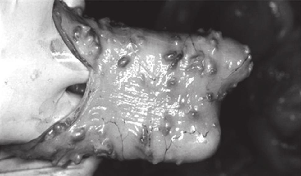 OS PARASITAS DE OVINOS 45 Trichostrongylus colubriformis em infecções pesadas causa enterite severa.