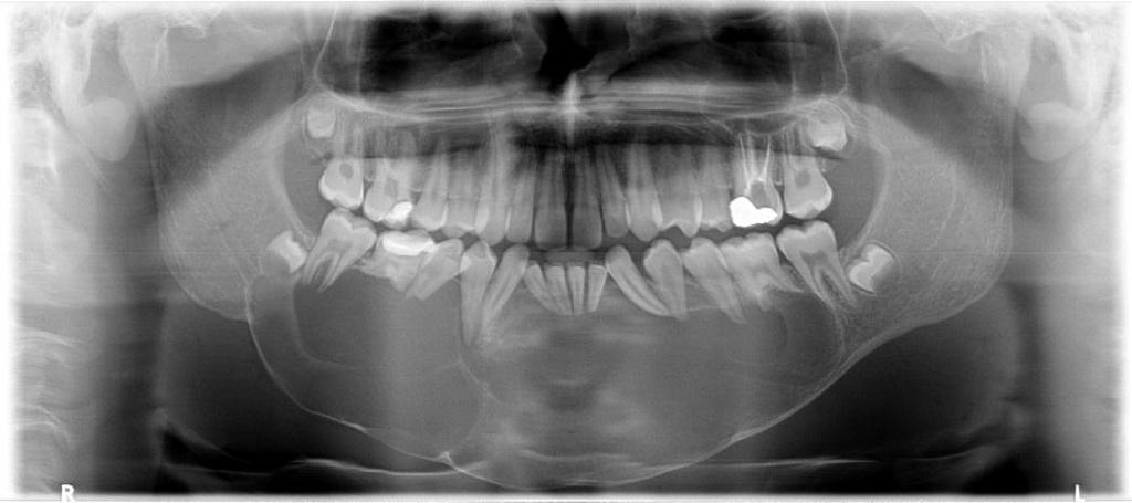 15 Figura 1 - Aspecto radiográfico pré-operatório Fonte: Radiografia