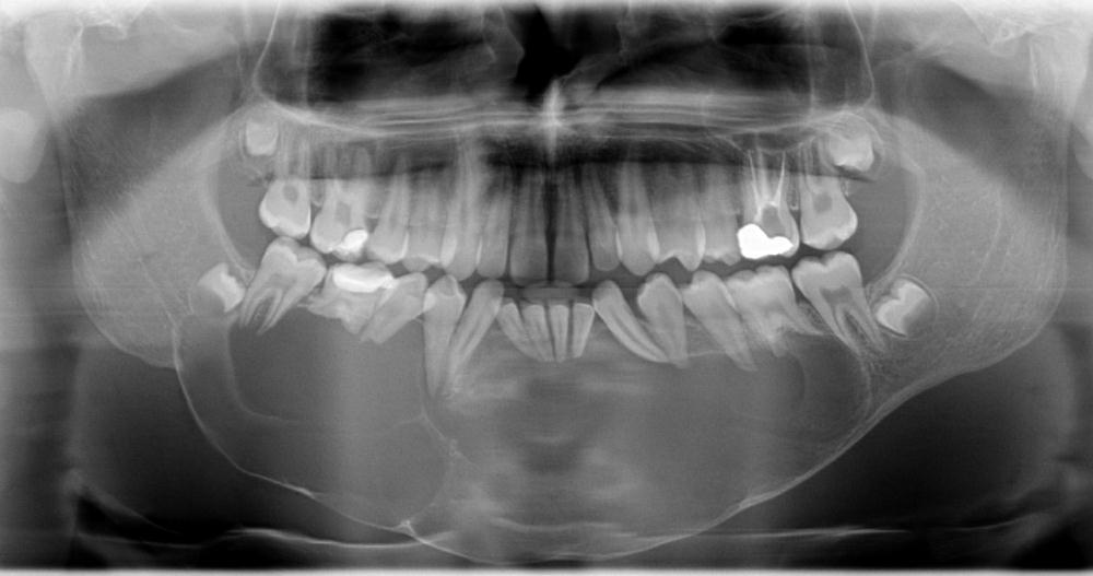 2012 Fonte: Radiografia panorâmica realizada no Centro Odontológico de Radiologia -COR, de Santa Maria/RS.
