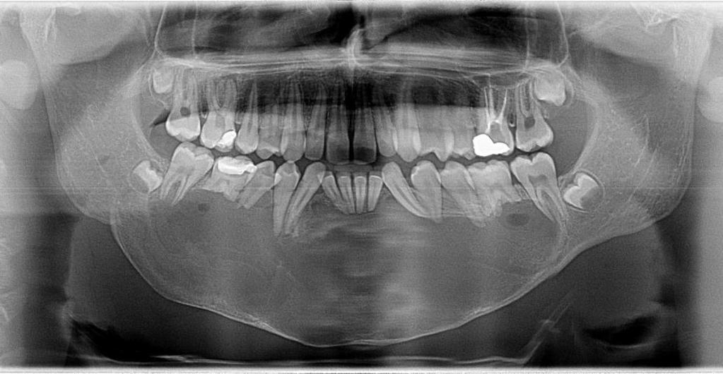 região do dente 37, lado esquerdo.
