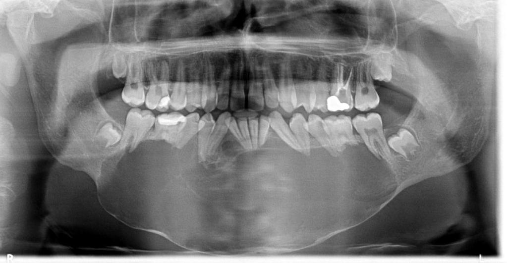 25 Figura 3 - Na região mentoniana e corpo mandibular (D/E), presença de lesão osteolítica, insuflativa, causando afilamento da cortical óssea adjacente compatível com ameloblastoma (observar