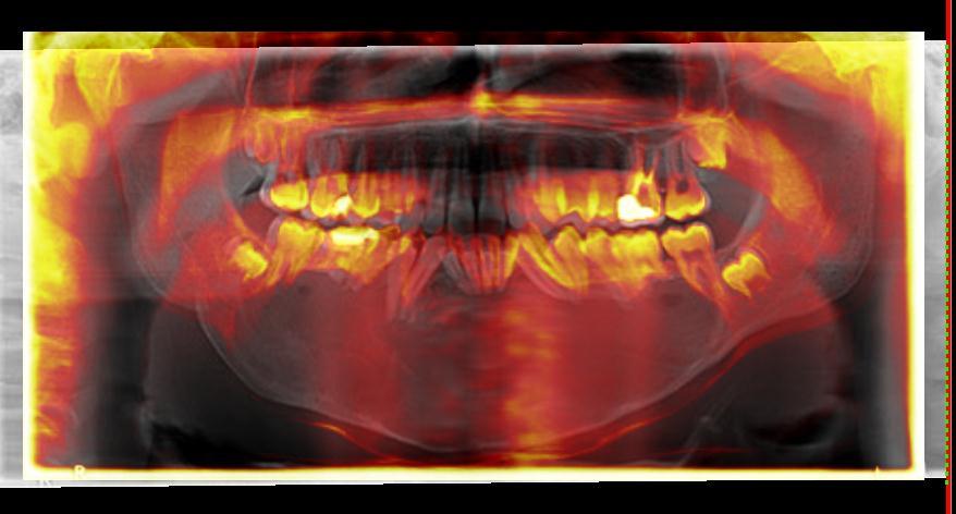 26 ANEXO B - SOBREPOSIÇÃO DE IMAGENS DE RADIOGRAFIAS